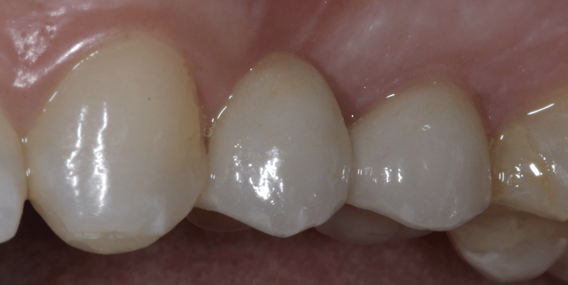 Combination bridges(Combining a crown and bonded retainer)