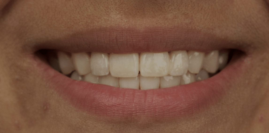 #7 veneer, #18 layered Zr pontic single bond bridge post op
