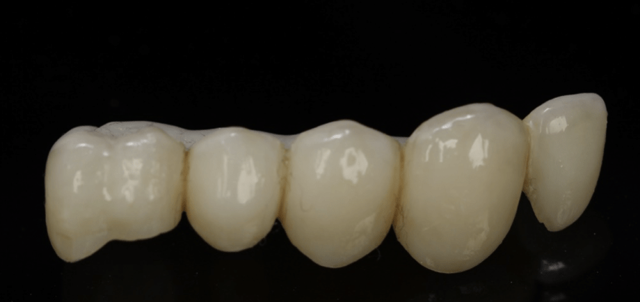Posterior milled Multilayer PMMA long term provisional