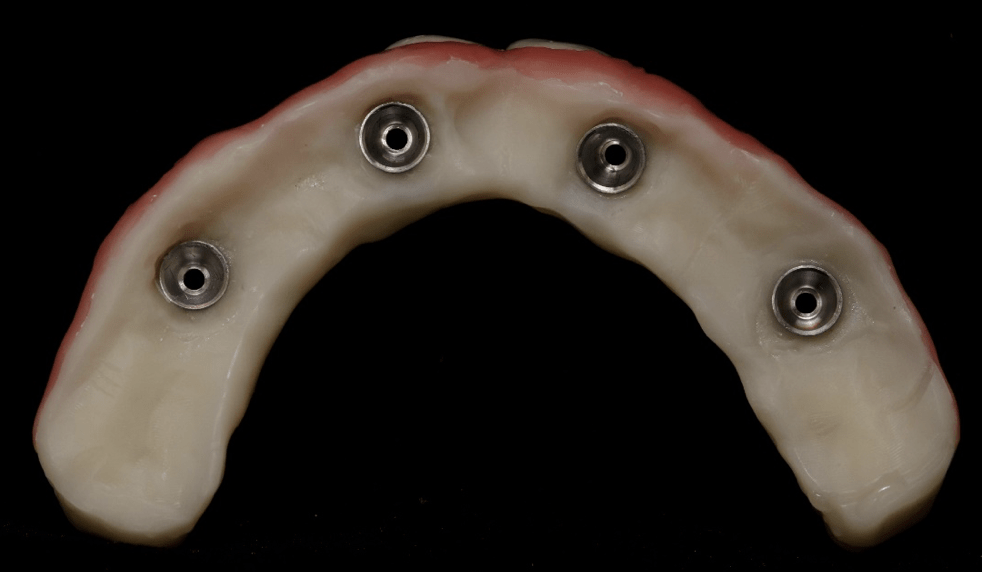 Provisional trial prosthesis<br />
