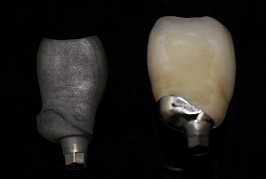 <br />
Molar porcelain fused to milled Ti base, one piece screw retained