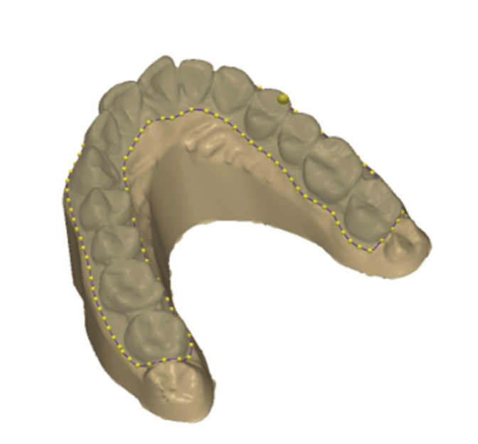 Printed Aligner 2