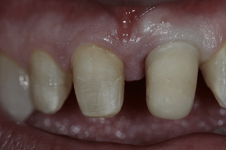 Preparations: 8 natural tooth, #9 ceramometal abutment<br />
