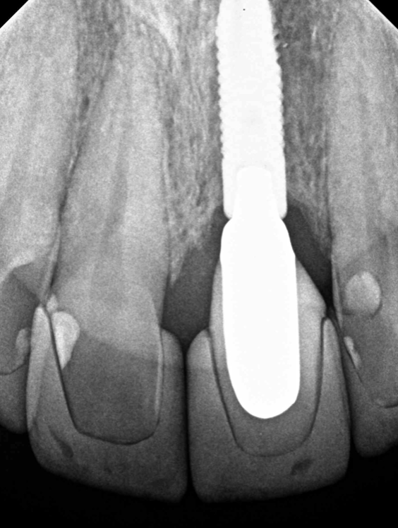 Post op x-ray Post op x-ray<br />